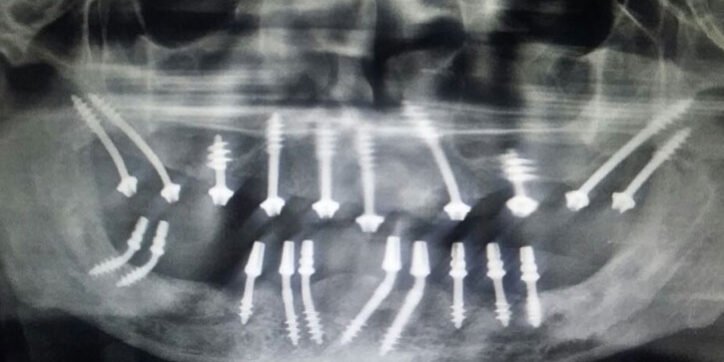 Simpladent India | Basal Implant Basal Implant