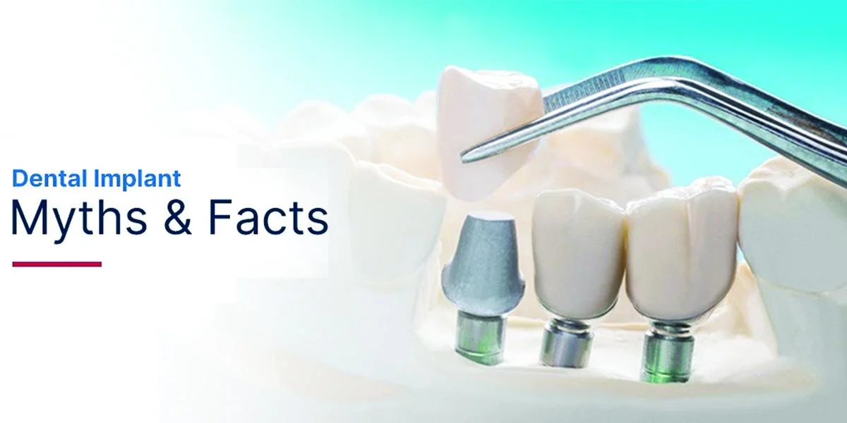Dental Implant - Myths & Facts