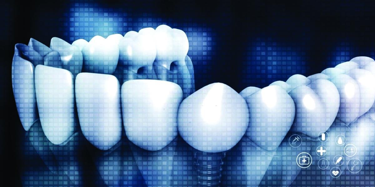 THE COMPENDIUM OF DENTAL IMPLANTS03. THE COMPENDIUM OF DENTAL IMPLANTS