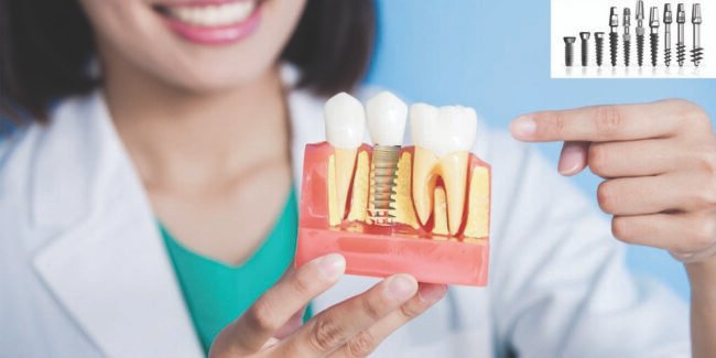 AN INTRODUCTION TO THE DENTAL IMPLANT INDUSTRY DENTAL IMPLANT