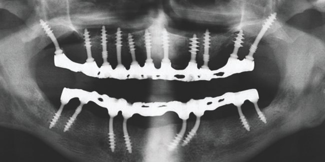 Implant02 Basal Implant