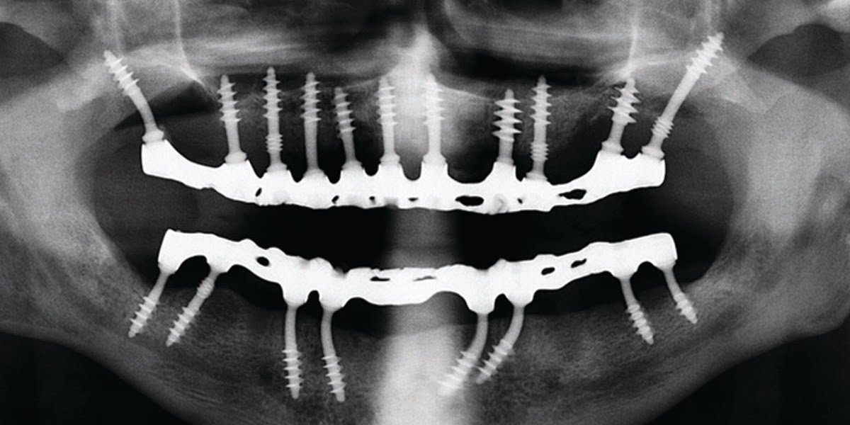 Implant02 Basal Implant