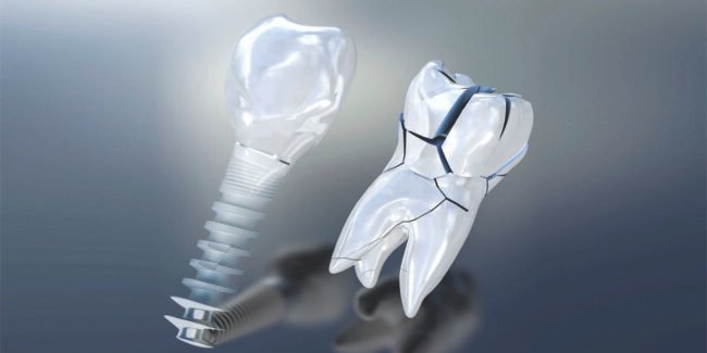 Dental_Implants_24_09_21 Dental Implant Course