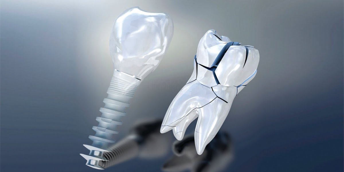 Dental_Implants_24_09_21 Dental Implant Course