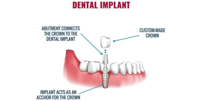 Best Dental Implants