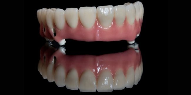 Dental Implant Dental Implant