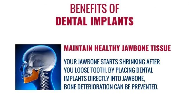 Full Dental Implants Full Dental Implants