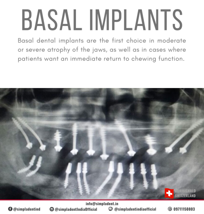 Basal Implantology