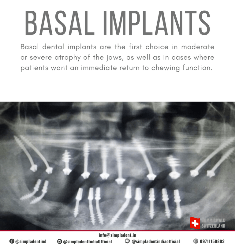 Basal Implantology Basal Implantology