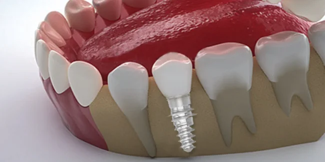 Dental Implants Reliable Tooth Replacement India Clinic