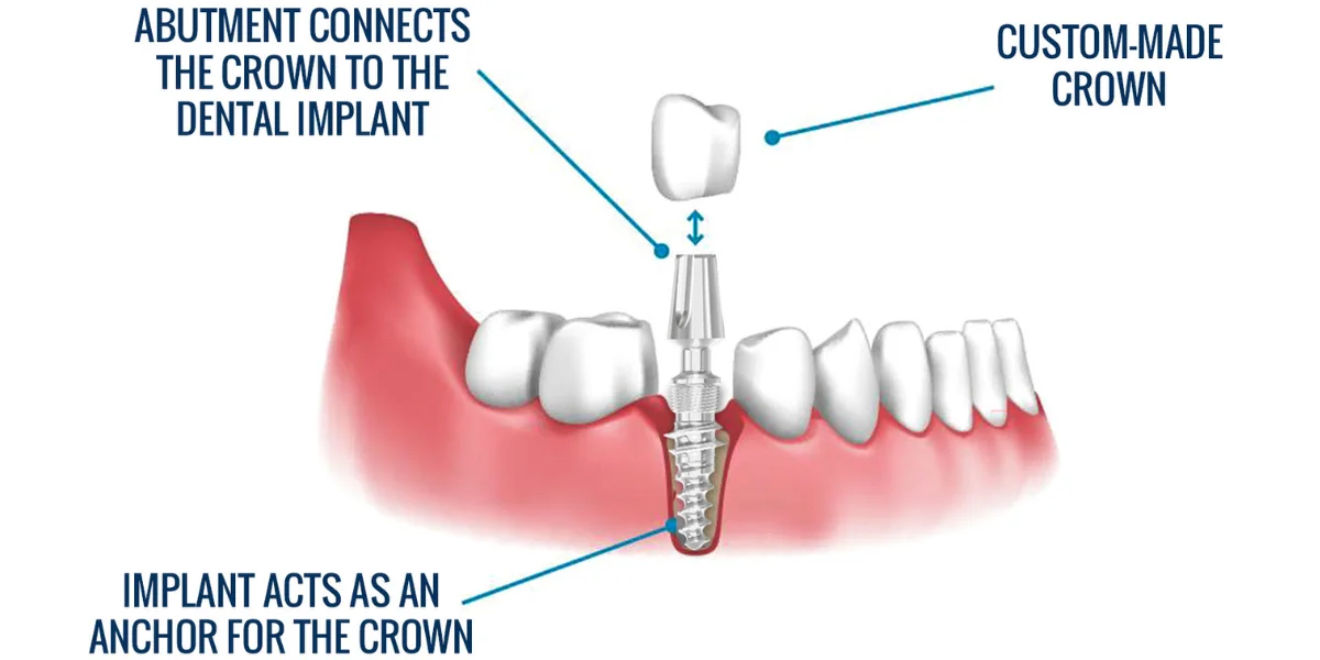 Achieve a Flawless Smile with Full Dental Implants full dental implants, complete tooth restoration, advanced dental solutions, permanent tooth replacement, comprehensive dental restoration