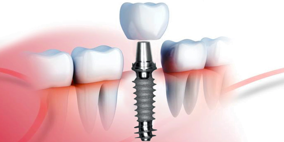 Full Dental Implant Smile-Restoration-Dental-Rehabilitation-Expert-Solutions