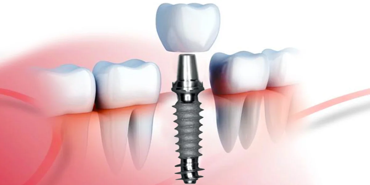 Full Dental Implant Smile-Restoration-Dental-Rehabilitation-Expert-Solutions