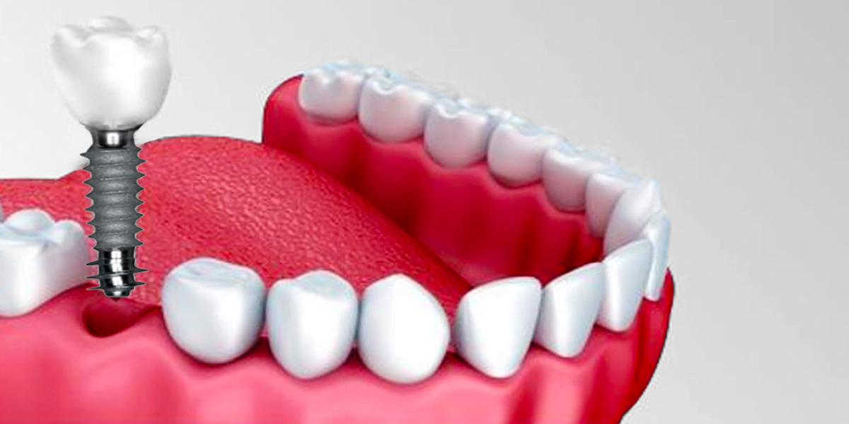 Dental Implants, tooth replacement, oral health, permanent solution, smile makeover