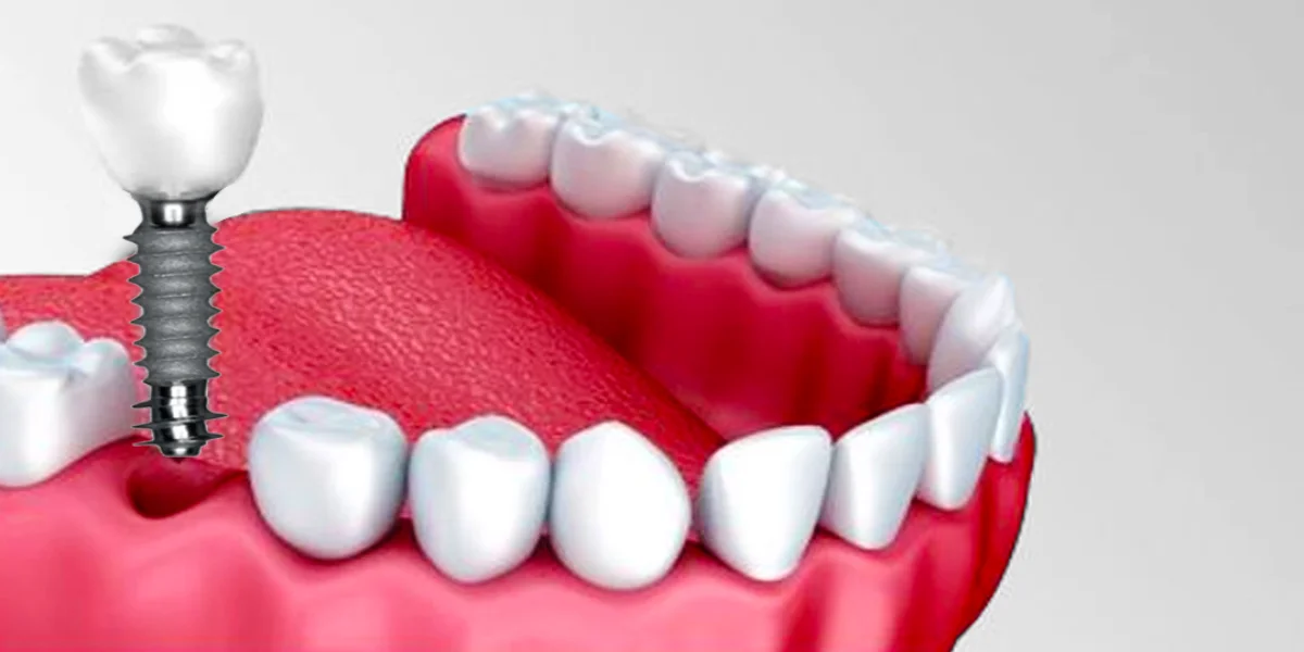 Revolutionize Your Smile with Dental Implants Dental Implants, tooth replacement, oral health, permanent solution, smile makeover