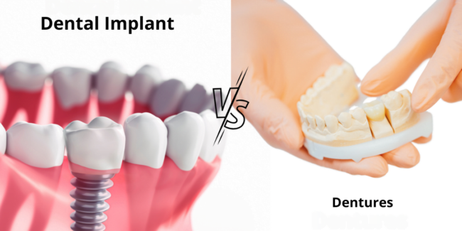 Dental Implants or Dentures , choosing dental implants, best dental solutions, dental implant benefits, dentures alternatives