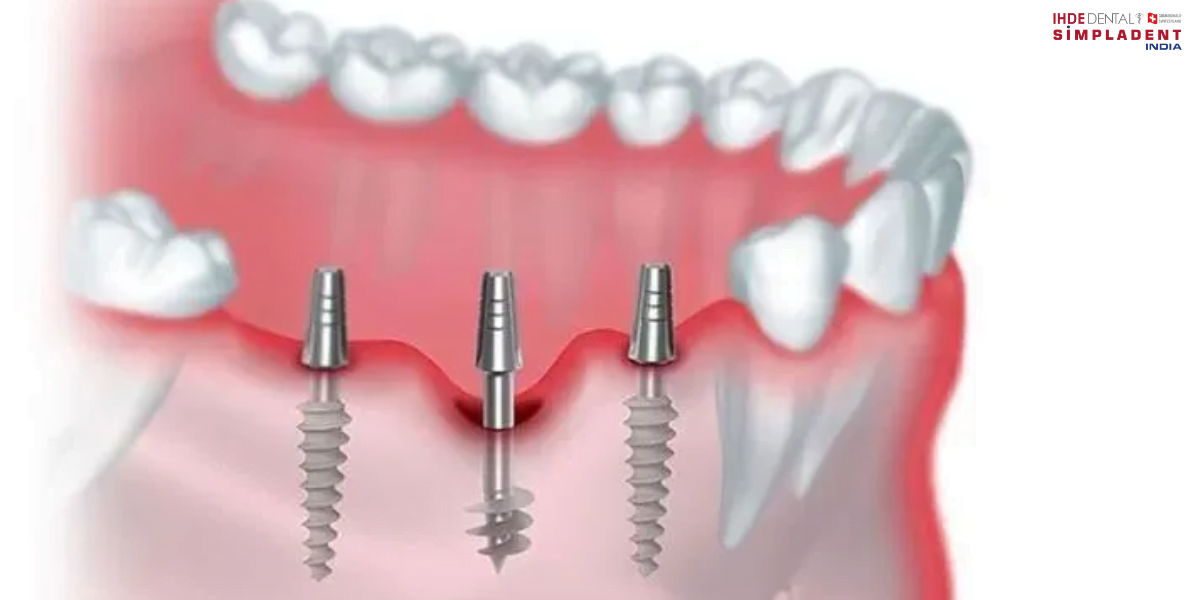 Advanced Dental Implant Solutions for missing teeth restoration, permanent dental implants for a confident smile, innovative dental implant technology, full mouth restoration with implants, immediate loading dental implants for faster results.