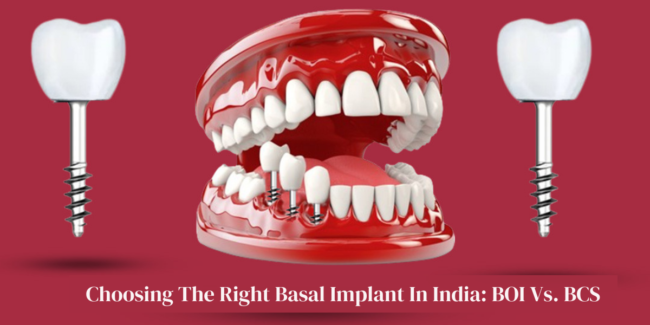 Advanced Basal Implants for Permanent Tooth Replacement Innovative basal implant system for immediate tooth replacement, advanced dental technology, strategic implants for missing teeth, permanent tooth solution, cutting-edge dental implant procedure