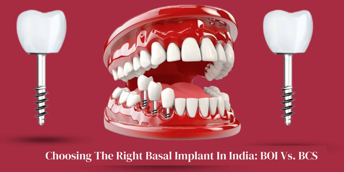 Innovative basal implant system for immediate tooth replacement, advanced dental technology, strategic implants for missing teeth, permanent tooth solution, cutting-edge dental implant procedure