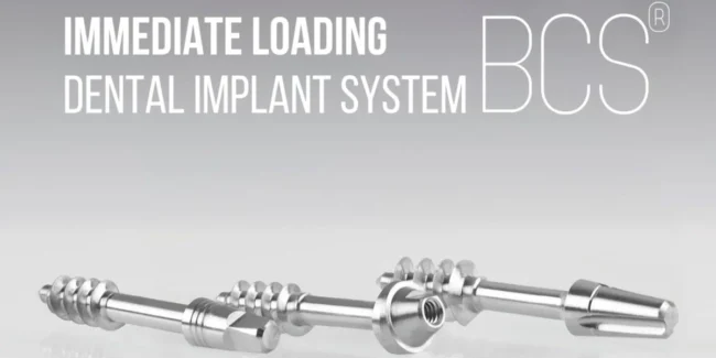 Immediate Loading Implants for missing teeth, fast dental restoration, permanent teeth in days, advanced implant technology, quick smile transformation
