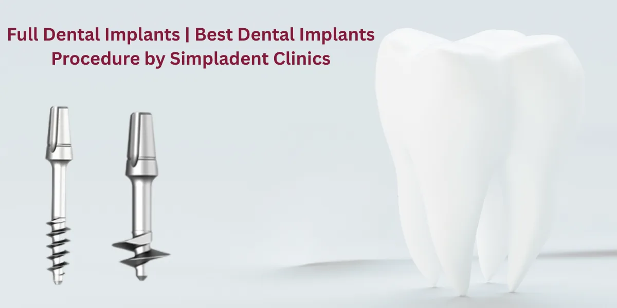 Best-Dental-Implants-2.png.webp