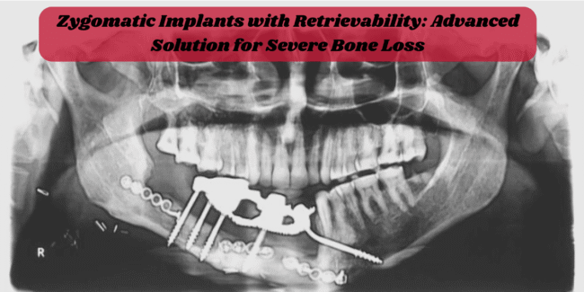 Advanced Zygomatic Implants for Severe Bone Loss Treatment Zygomatic implants procedure, advanced dental implants, full mouth rehabilitation, best implant solution for bone loss, immediate loading implants, expert implant surgeon