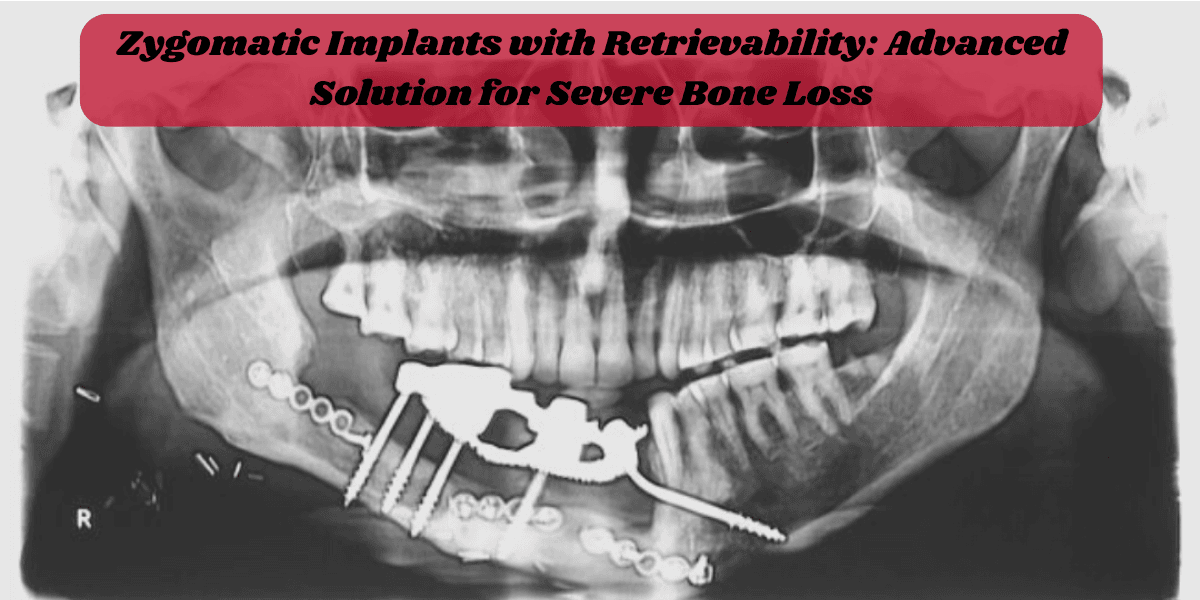 Advanced Zygomatic Implants for Severe Bone Loss Treatment Zygomatic implants procedure, advanced dental implants, full mouth rehabilitation, best implant solution for bone loss, immediate loading implants, expert implant surgeon