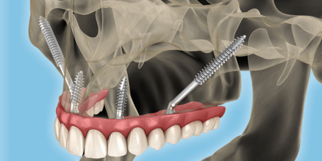 zygomatic implants treatment, advanced dental implants, graftless dental implants, immediate load implants, full mouth dental implants, bone loss dental solution