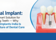 Basal implants India, immediate loading dental implants, full mouth dental implants, painless tooth replacement, advanced basal implant treatment, permanent teeth in 2 days
