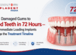 Immediate Loading Implants, same day dental implants, basal implants India, full mouth dental implants, fixed teeth in 72 hours, strategic implantology treatment