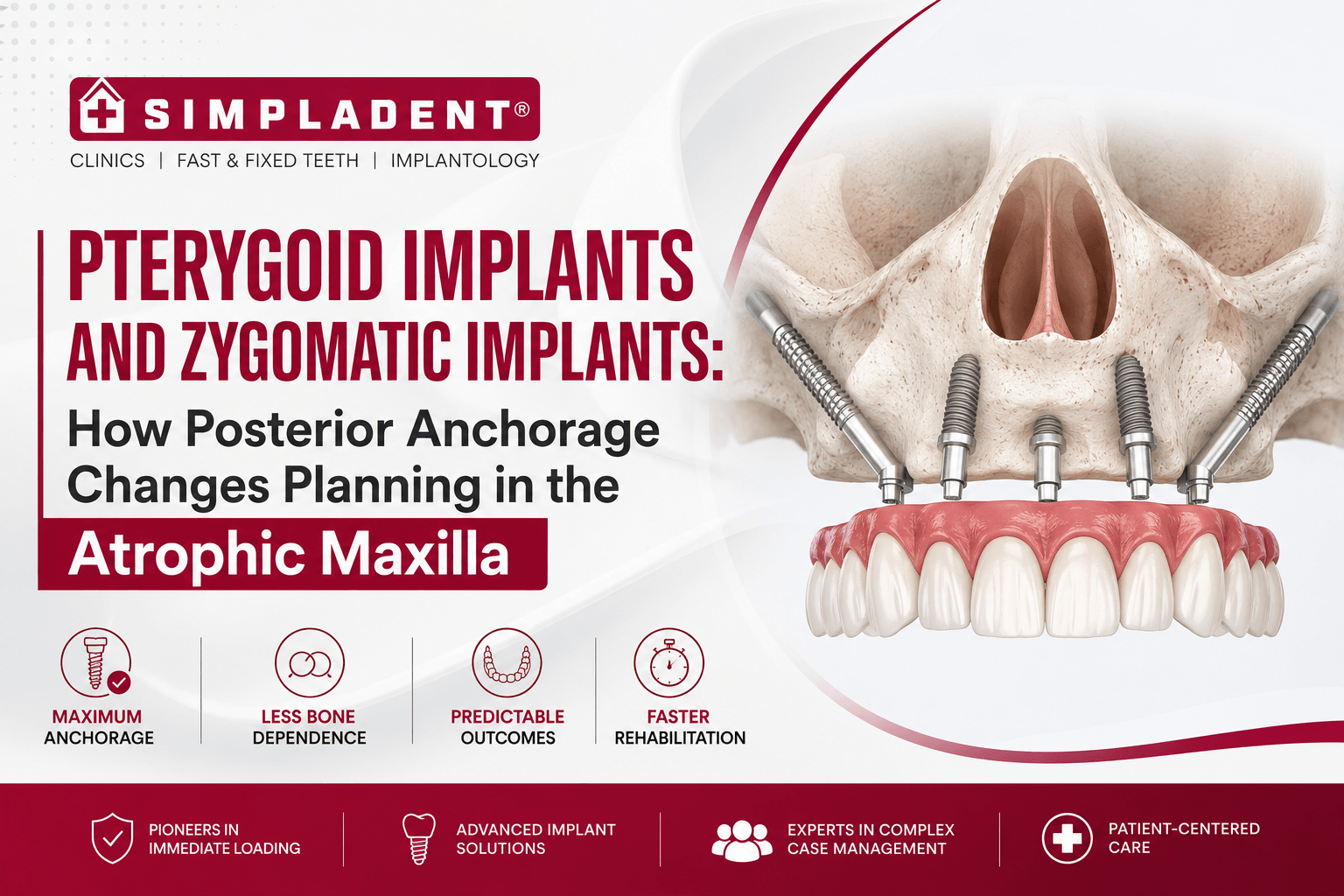Zygomatic Implants