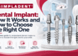 Dental implant